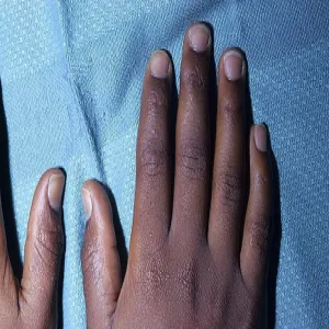 Grudki na dłoniach palcach liszaj lsniący