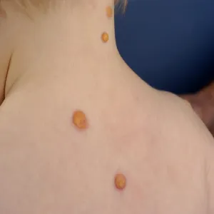 Grudki na plecach u dziecka żółtakoziarniniakowatość młodzieńcza