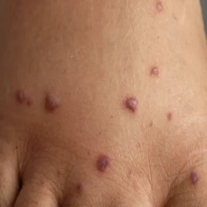 Grudki na skórze choroba Behçeta 