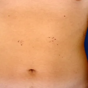 Grudki o czerwonawo-fioletowym zabarwieniu choroba Fabry'ego