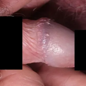 Grudki perliste w rowku zażołędnym penisa