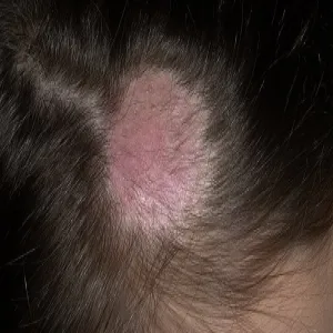 Grzybica antropofilna zdjęcie