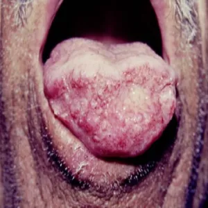 Grzybica choroba Gilchrista