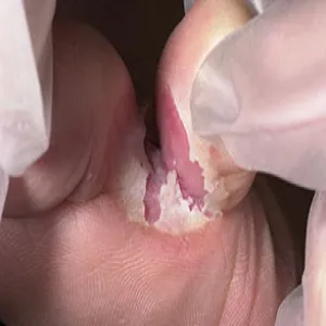 Grzybica między palcami nóg stopa sportowca