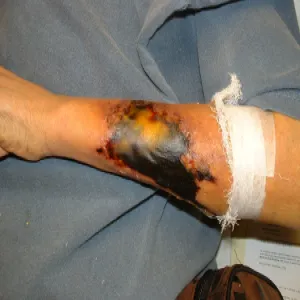 Grzybica oportunistyczna zygomykoza