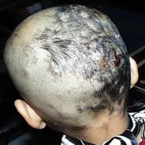 Grzybica skóry głowy galeria zdjęć