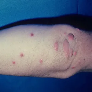 Guz na łokciu zdjęcia żółtak bulwiasty