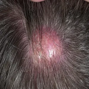 Guzek kaszak na głowie