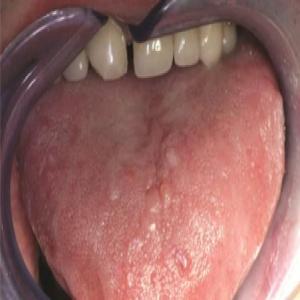 Guzki na języku choroba amyloidozy skóry