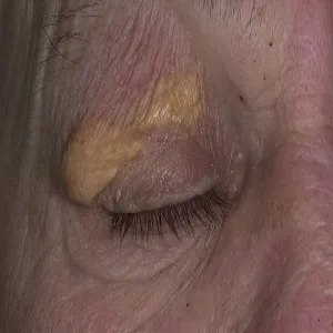 Guzki na powiece oka żółtaki 