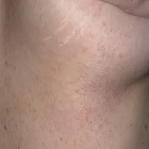 Guzki na skórze pod piersiami syringoma