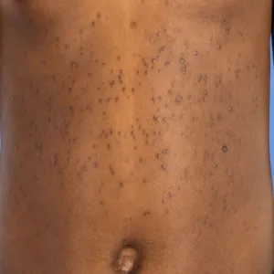 Guzki na skórze syringoma