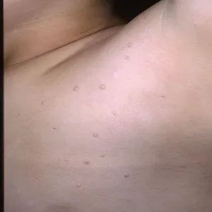 Guzki pod pachą u dziecka 