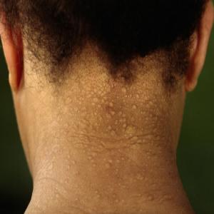 Guzowate zmiany na skórze szyi - zanik plamisty skóry