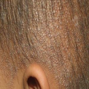 Hiperkeratoza skóry głowy
