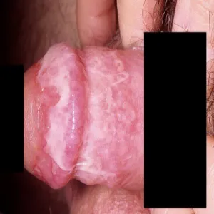 Infekcja bakteryjna prącia zapalenie napletka