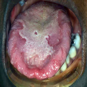 Język geograficzny u dorosłego