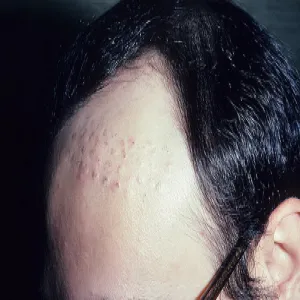 Jak wygląda łysienie androgenowe u mężczyzn zdjęcia