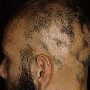 Jak wygląda łysienie plackowate