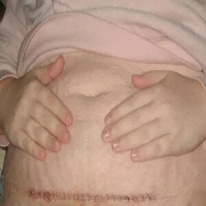 Jak wygląda bliznowiec po cesarce