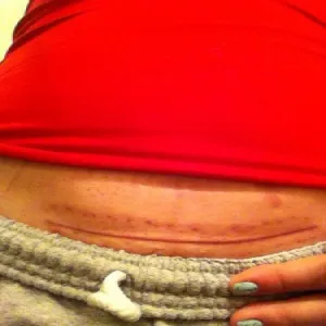 Jak wygląda keloid po cesarce