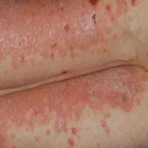 Jak wygląda liszaj czerwony zdjęcia