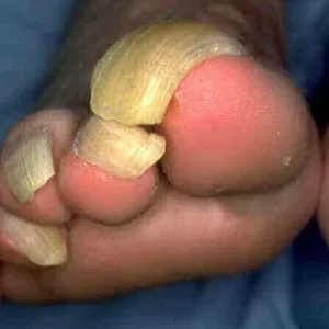 Jak wygląda onychogryfoza