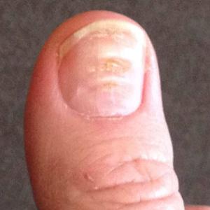 Jak wygląda pofalowana płytka paznokcia