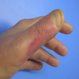 Jak wygląda różyca u ludzi