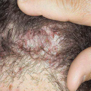 Jak wygląda stan zapalny mieszków włosowych zdjęcie