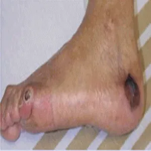 Jak wygląda stopa cukrzycowa