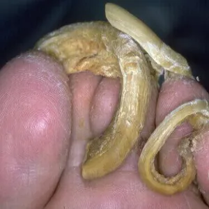 Jak wygląda szponowatość paznokci