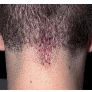 Jak wygląda trądzik keloidowy nuchae 