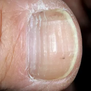 Jak wyglądają linie Beau