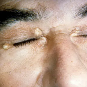 Kępki żółte objawy