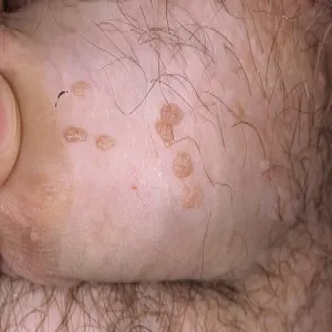 Kłykciny kończyste u mężczyzny