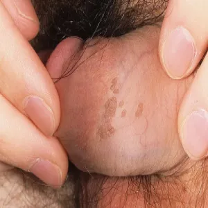 Kłykciny kończyste u mężczyzn