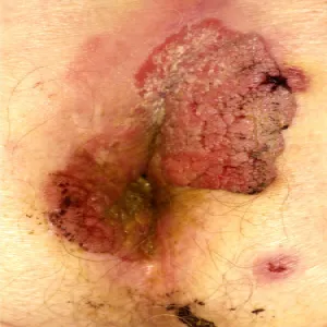 Kłykciny olbrzymie kończyste 