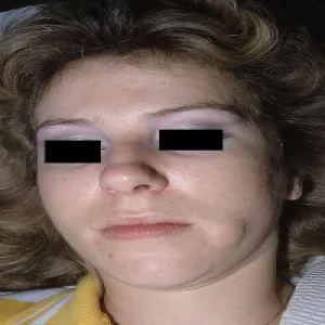 Kaszak na twarzy