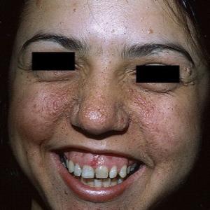 Kaszka na twarzy choroba gruczolak łojowy