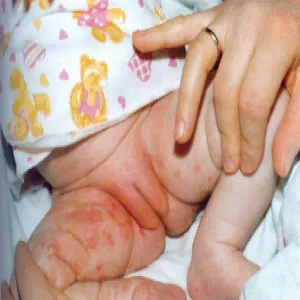 Kiła osutka grudkowa 