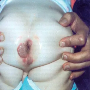 Kiła wrodzona kłykciny płaskie u dzieci