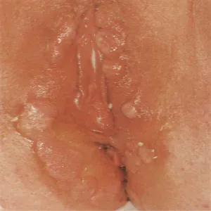 Kiła wysypka miejsca intymne kobiet