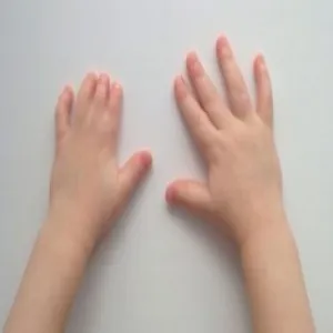 krótkie palce u rąk choroba brachydaktylia