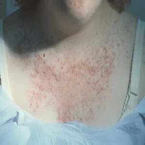 Krostki dekolt choroba Dariera