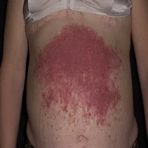 Krostki na brzuchu choroba Dariera