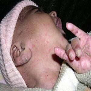 Krostki na szyi twarzy u dziecka świerzb