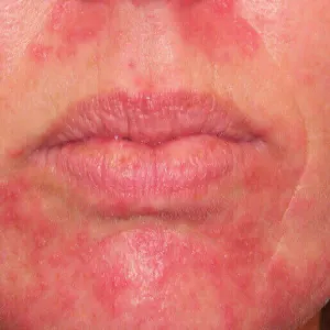 Krostki rozmieszczone w okolicy okołoustnej