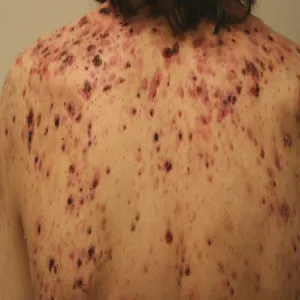 Krosty na ciele trądzik piorunujący