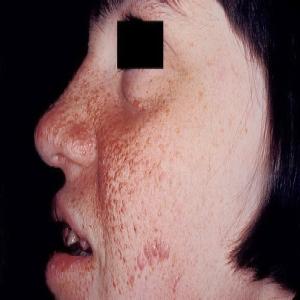 Krosty na twarzy choroba gruczolak łojowy